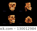 Computed tomography of adult female patient with dental root and implant treatments. Dental x-ray of an adult patient showing teeth, jaws and a dental implant. Modern digital tomography for dentistry 130012984