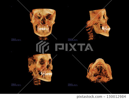 Computed tomography of adult female patient with dental root and implant treatments. Dental x-ray of an adult patient showing teeth, jaws and a dental implant. Modern digital tomography for dentistry 130012984