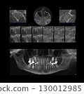 Computed tomography of adult female patient with Temporomandibular joint (TMJ, joint of lower jaw), implant treatments. X-ray of an adult patient showing teeth, jaws, dental implant, mandibular joint 130012985