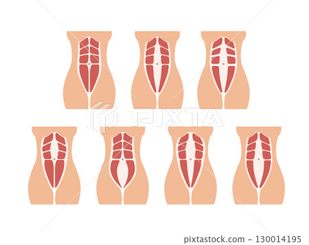 Different types of Diastasis. Diastasis in a woman before, during and after pregnancy. The anatomy of a Woman. A woman's muscular corset before and after childbirth. Vector illustration 130014195