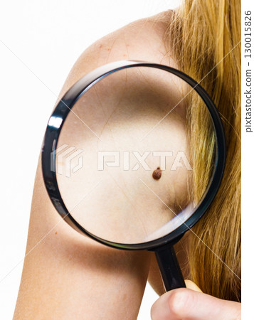 Closeup brown mole on skin. 130015826