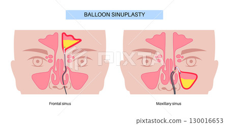 Balloon sinuplasty poster Balloon sinuplasty poster 130016653