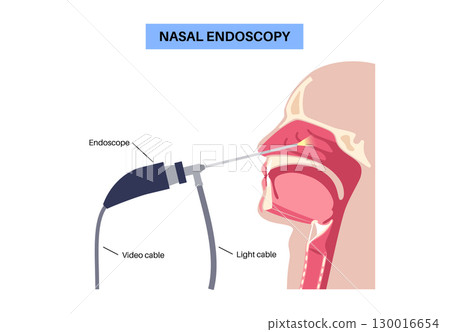 Nasal endoscopy poster 130016654