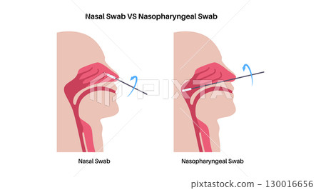 Nasopharyngeal and nasal swab Nasopharyngeal and nasal swab 130016656