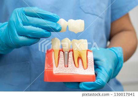 Dental implant, artificial tooth roots into jaw, root canal of dental treatment, gum disease, teeth model for dentist studying about dentistry. 130017041