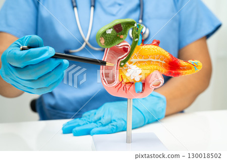 Pancreatitis, pancreatic cancer, Asian doctor with pancreas, gallbladder and bile duct human anatomy model at hospital. 130018502