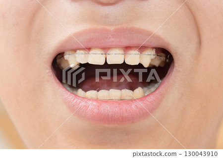 Image of teeth straightening 130043910