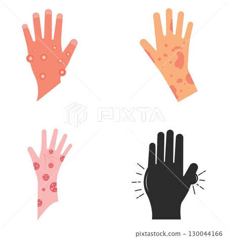 Skin rash, insect bites allergy reaction. irritation on hand logo vector illustration Skin rash, insect bites allergy reaction. irritation on hand logo vector illustration 130044166