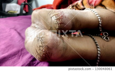 Close-Up of Cracked Heels and Bare Feet 130048061