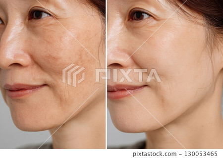 Before and after images of cosmetic surgery 130053465