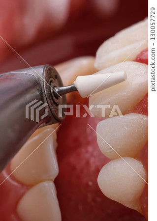 Dental polishing tool close up with rubber prophy cup cleaning tooth surface macro photography 130057729