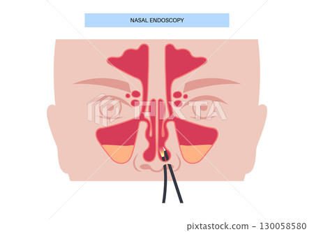Nasal endoscopy poster Nasal endoscopy poster 130058580