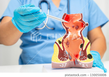 Asian doctor with rectum and hemorrhoid human anatomy model at hospital, inflamed vascular structure. 130058806