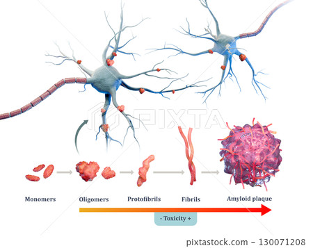 Amyloid plaques formation in Alzheimer disease 130071208
