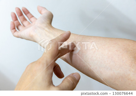 在汗疹上塗抹藥膏 在汗疹上塗抹藥膏 130076644