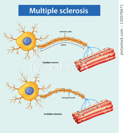 Comparison of Healthy Neuron and Multiple Sclerosis Damage 130076671