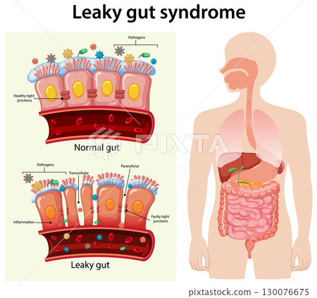 Comparison of Normal and Leaky Gut Syndrome Illustration 130076675