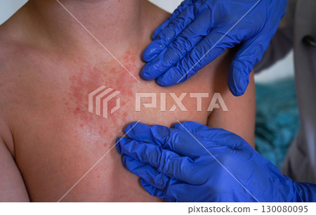 The doctor observes the boy for symptoms of chickenpox. 130080095