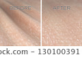 Human skin surface before and after wrinkle reduction treatment. 3D rendered illustration 130100391