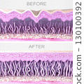 Skin layers cross-sectioned before and after anti-aging treatment. 3D rendered illustration 130100392