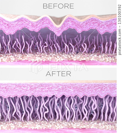 Skin layers cross-sectioned before and after anti-aging treatment. 3D rendered illustration Skin layers cross-sectioned before and after anti-aging treatment. 3D rendered illustration 130100392