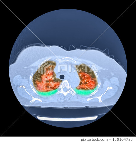 Lungs affected by Covid-19 pneumonia, CT scan 130104783