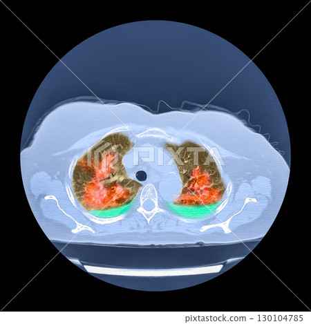 Lungs affected by Covid-19 pneumonia, CT scan 130104785