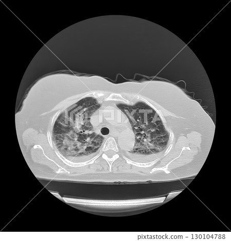 Lungs affected by Covid-19 pneumonia, CT scan 130104788