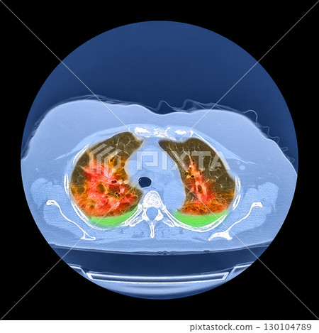 Lungs affected by Covid-19 pneumonia, CT scan 130104789