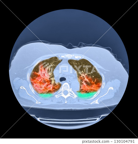 Lungs affected by Covid-19 pneumonia, CT scan 130104791