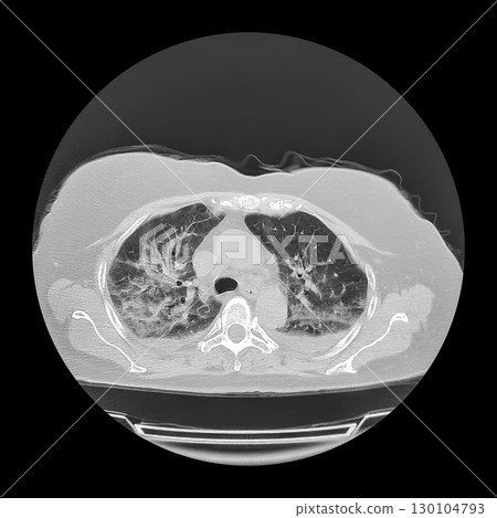 Lungs affected by Covid-19 pneumonia, CT scan 130104793