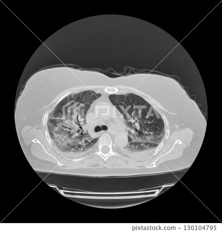 Lungs affected by Covid-19 pneumonia, CT scan 130104795