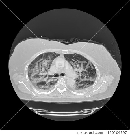 Lungs affected by Covid-19 pneumonia, CT scan 130104797