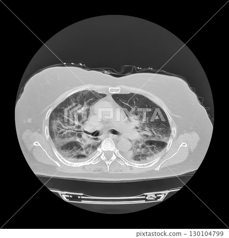 Lungs affected by Covid-19 pneumonia, CT scan 130104799