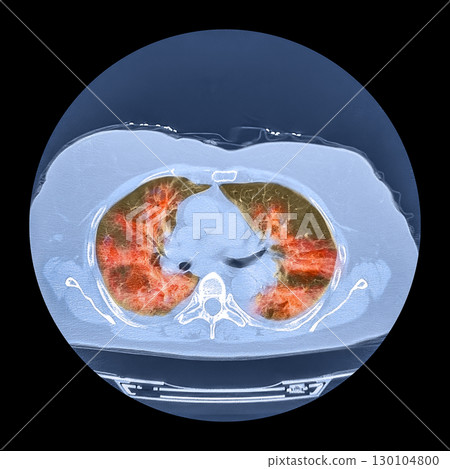 Lungs affected by Covid-19 pneumonia, CT scan 130104800
