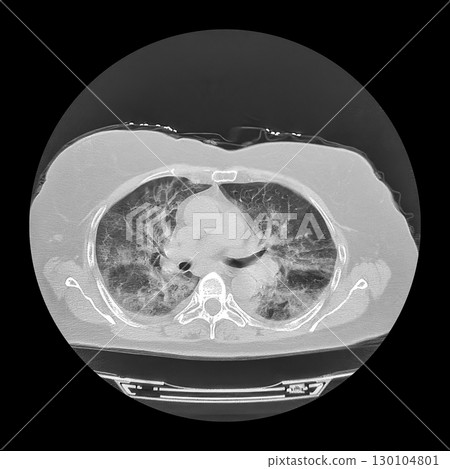 Lungs affected by Covid-19 pneumonia, CT scan 130104801
