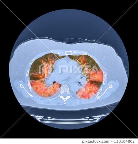 Lungs affected by Covid-19 pneumonia, CT scan 130104802