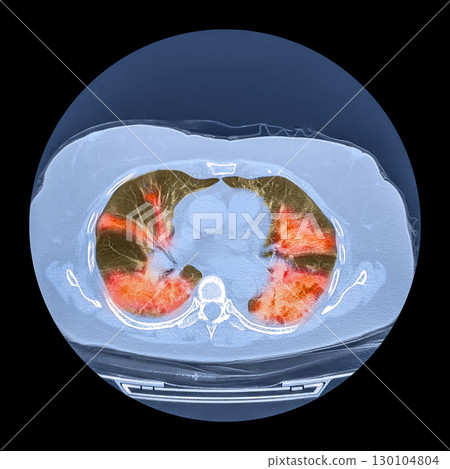 Lungs affected by Covid-19 pneumonia, CT scan 130104804