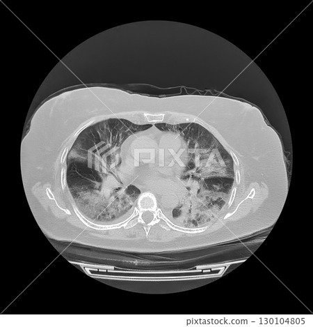 Lungs affected by Covid-19 pneumonia, CT scan Lungs affected by Covid-19 pneumonia, CT scan 130104805