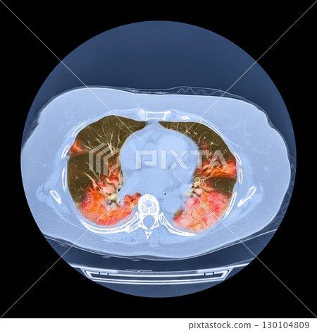 Lungs affected by Covid-19 pneumonia, CT scan 130104809