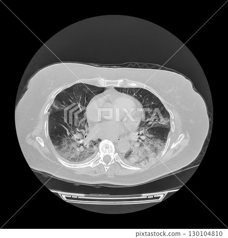 Lungs affected by Covid-19 pneumonia, CT scan 130104810