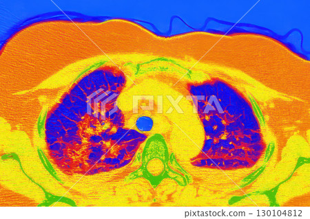 Lungs with COVID-19 pneumonia, color-enhanced CT scan showing normal lung tissue in blue and affected bilateral areas with ground-glass opacities and crazy-paving patterns in orange-red Lungs with COVID-19 pneumonia, color-enhanced CT scan showing normal lung tissue in blue and affected bilateral areas with ground-glass opacities and crazy-paving patterns in orange-red 130104812