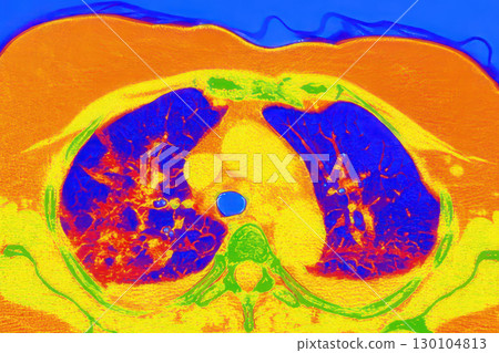 Lungs with COVID-19 pneumonia, color-enhanced CT scan showing normal lung tissue in blue and affected bilateral areas with ground-glass opacities and crazy-paving patterns in orange-red 130104813