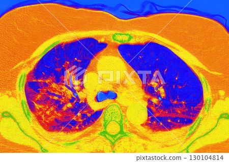 Lungs with COVID-19 pneumonia, color-enhanced CT scan showing normal lung tissue in blue and affected bilateral areas with ground-glass opacities and crazy-paving patterns in orange-red 130104814