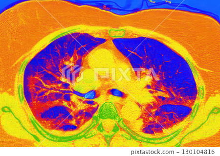 Lungs with COVID-19 pneumonia, color-enhanced CT scan showing normal lung tissue in blue and affected bilateral areas with ground-glass opacities and crazy-paving patterns in orange-red 130104816