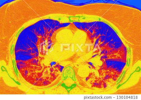 Lungs with COVID-19 pneumonia, color-enhanced CT scan showing normal lung tissue in blue and affected bilateral areas with ground-glass opacities and crazy-paving patterns in orange-red 130104818