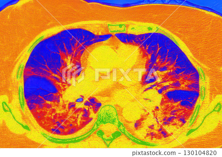 Lungs with COVID-19 pneumonia, color-enhanced CT scan showing normal lung tissue in blue and affected bilateral areas with ground-glass opacities and crazy-paving patterns in orange-red 130104820