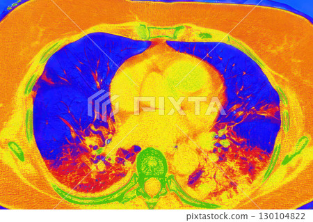 Lungs with COVID-19 pneumonia, color-enhanced CT scan showing normal lung tissue in blue and affected bilateral areas with ground-glass opacities and crazy-paving patterns in orange-red 130104822