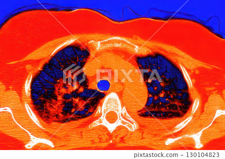 Lungs with COVID-19 pneumonia, color-enhanced CT scan showing normal lung tissue in dark blue and affected bilateral areas with ground-glass opacities and crazy-paving patterns in red 130104823