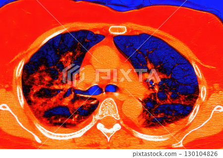 Lungs with COVID-19 pneumonia, color-enhanced CT scan showing normal lung tissue in dark blue and affected bilateral areas with ground-glass opacities and crazy-paving patterns in red 130104826